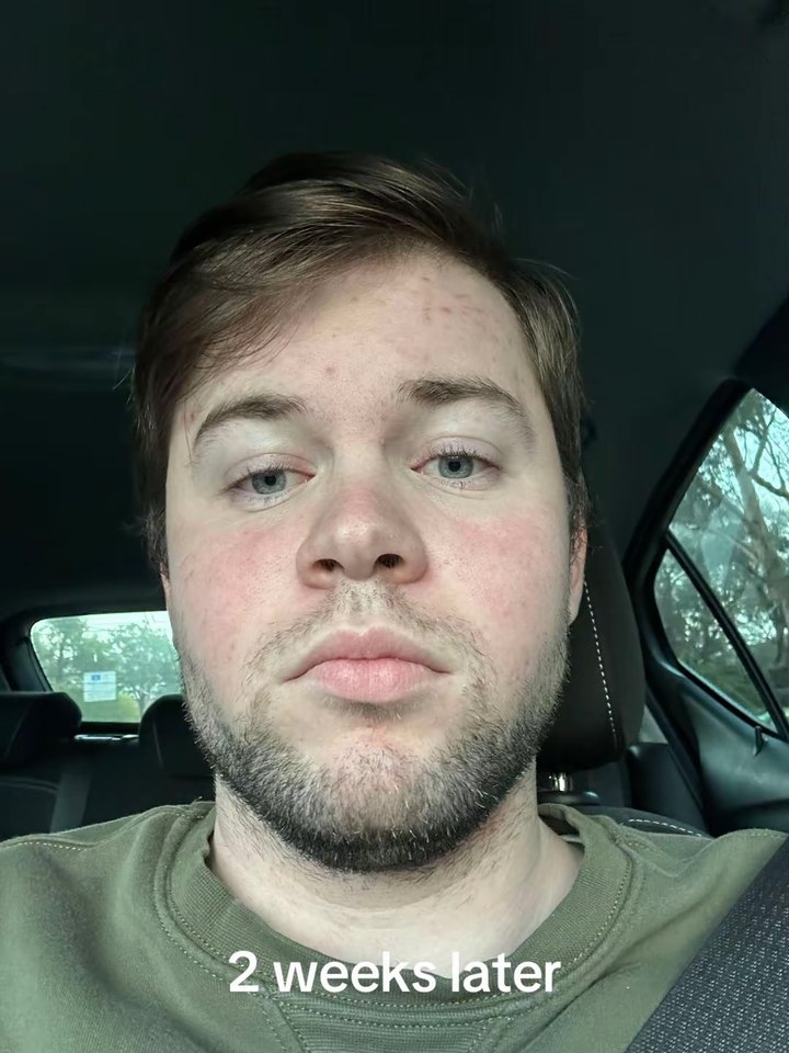 Me two weeks later in my car in the hospital car park, my face visibly thinner