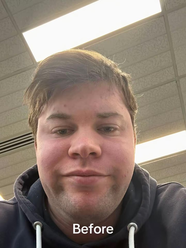 Me in July 2025 under office lights, my face swollen